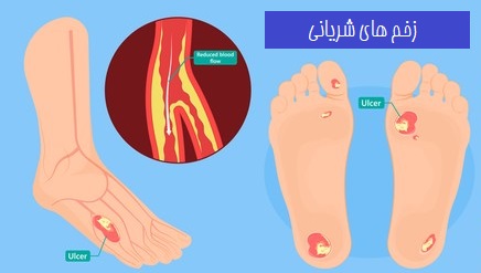 زخم های شریانی