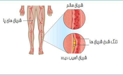 زخم های ایسکمیک