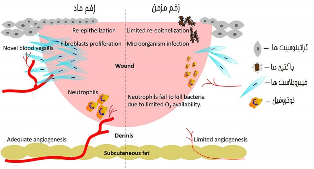 تفاوت زخم حاد و مزمن