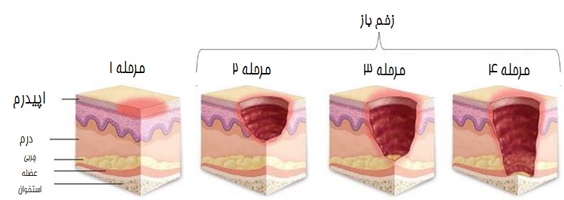 زخم بستر