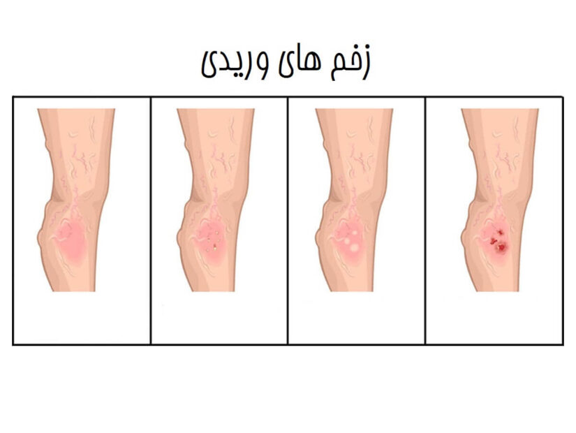 زخم های وریدی