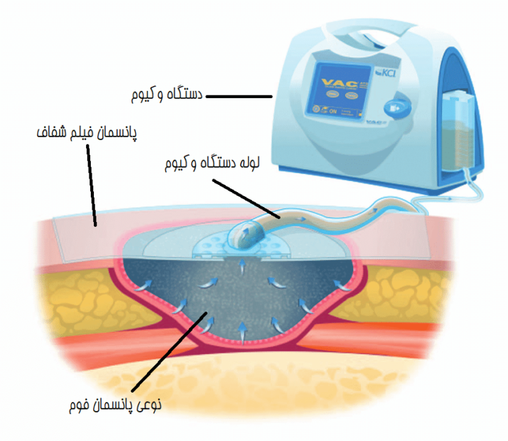 وکیوم تراپی