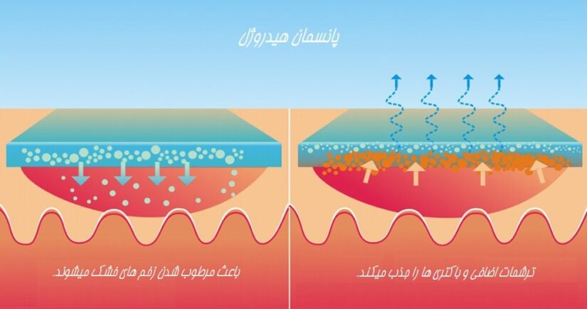 پانسمان هیدروژل